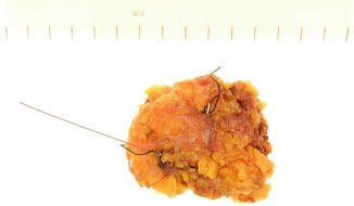 Fig 11 Specimen with marking sutures If the lesion was originally detected - photo 1