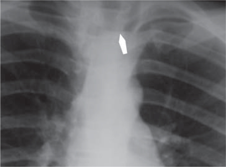 CXR An airfluid level arrow is present in the superior mediastinum in - photo 9