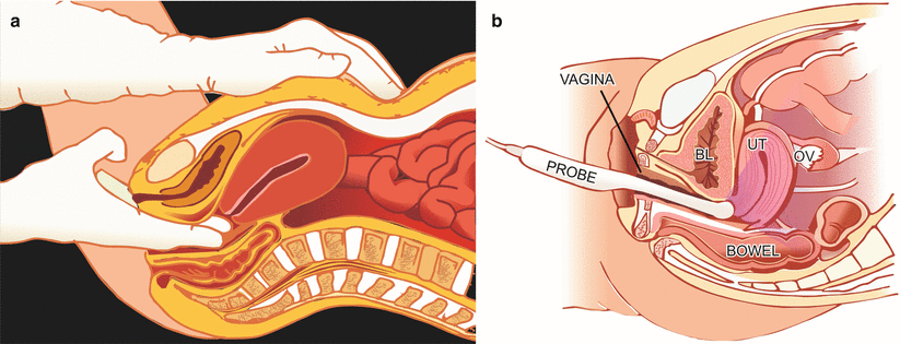 Fig 21 a Bimanual per vaginal examination which uses touch sensation to - photo 1