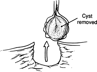 Figure 19 A third group includes decubitus ulcers hidradenitis - photo 9