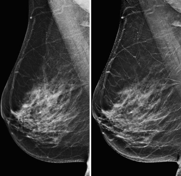Fig 12 Left image is a 2D mammogram and the right image is a 2D image - photo 2
