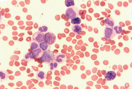 A sample of blood from a patient with CML The excess abnormal white blood - photo 5