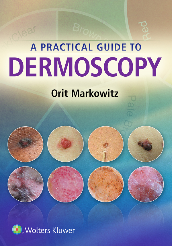 A PRACTICAL GUIDE TO DERMOSCOPY Orit Markowitz MD FAAD Director of Pigmented - photo 1