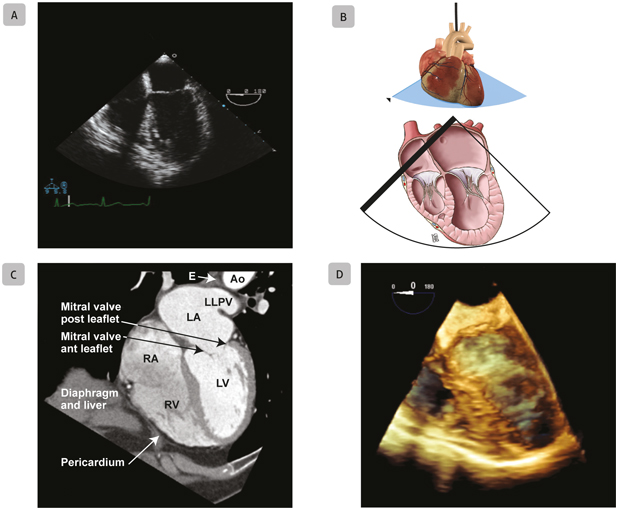 A1 Mid-Esophageal Four-Chamber Mid-esophageal four-chamber views obtained with - photo 5