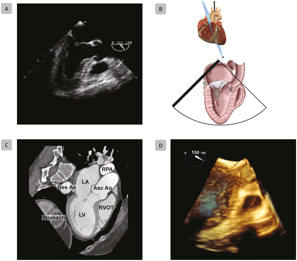 A4 Mid-Esophageal Long-Axis Mid-esophageal long-axis views obtained with - photo 11