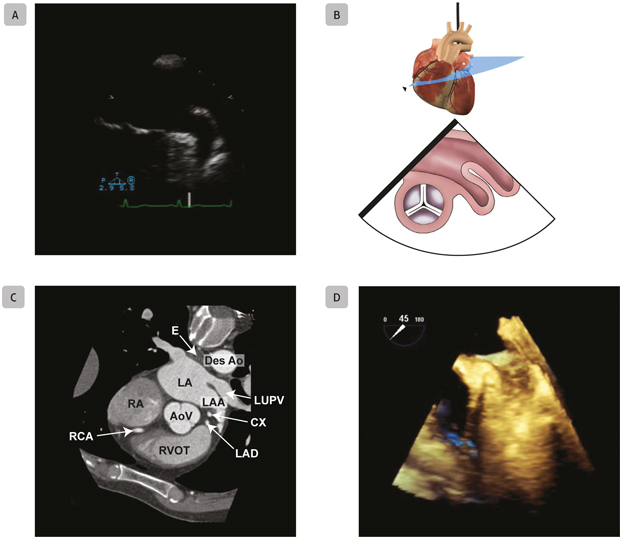 A5 Mid-Esophageal Left Atrial Appendage Mid-esophageal left atrial appendage - photo 13