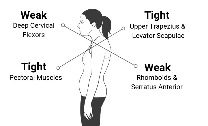 Upper crossed syndrome is a pattern of muscular imbalances and postural - photo 2
