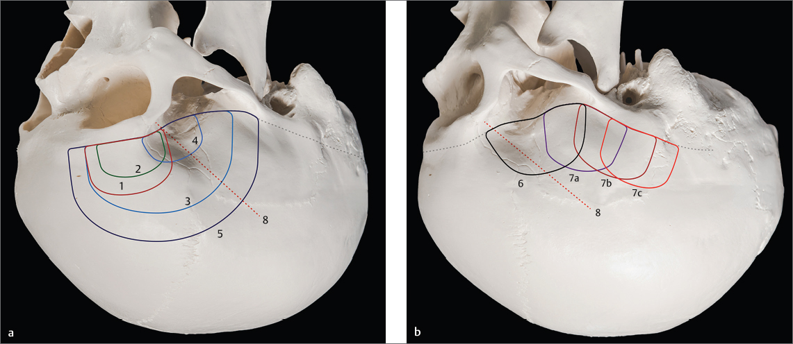 Fig 11 Systematics of skull base craniotomiessupratentorial Supratentorial - photo 1