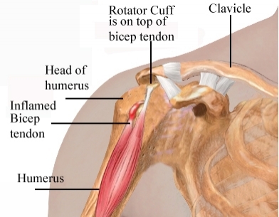 Do not ignore the pain W ithout treatment rotator cuff problems may lead to - photo 3