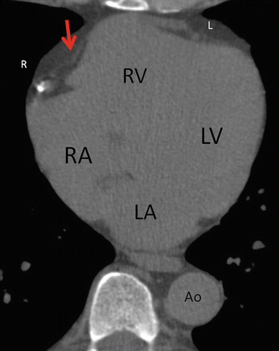 Fig 11 A non-contrast CT scan of the heart Quite a bit of information can be - photo 1