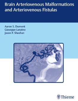 Jason P. Sheehan Brain Arteriovenous Malformations and Arteriovenous Fistulas