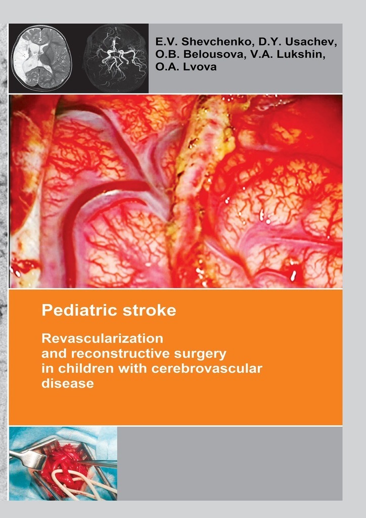 Pediatric stroke Revascularization and reconstructive surgery in children with - photo 1