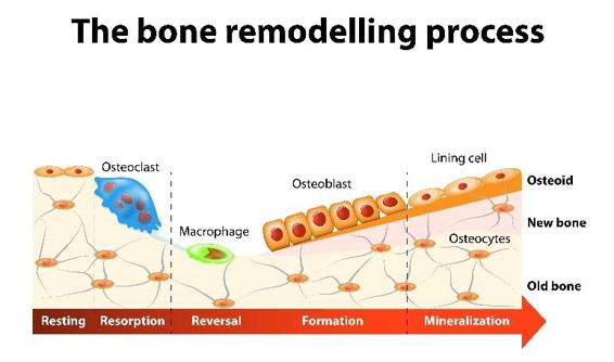 Bone remodeling happens when new bone replaces old bone The old bone is - photo 4