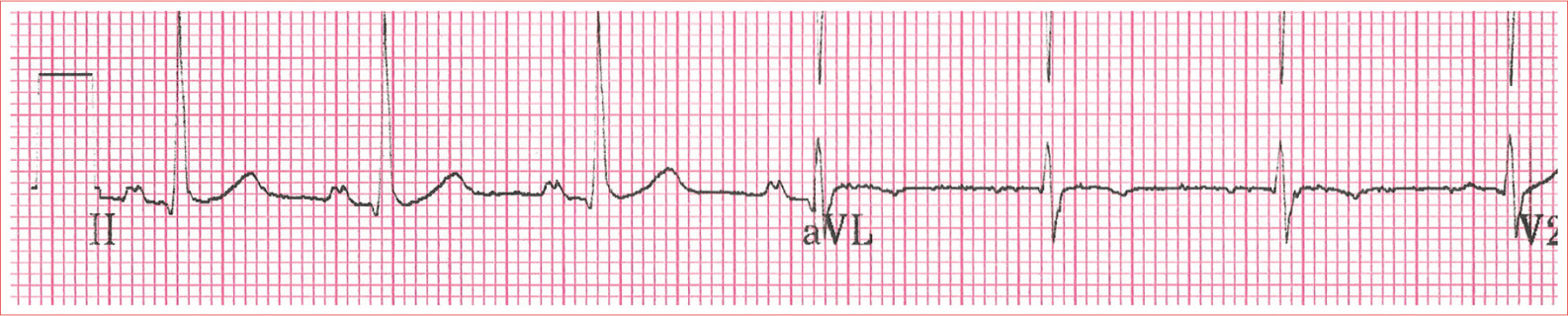 Regular rhythm Rate of 60 to 100 beatsminute QRS complexes are typically less - photo 1