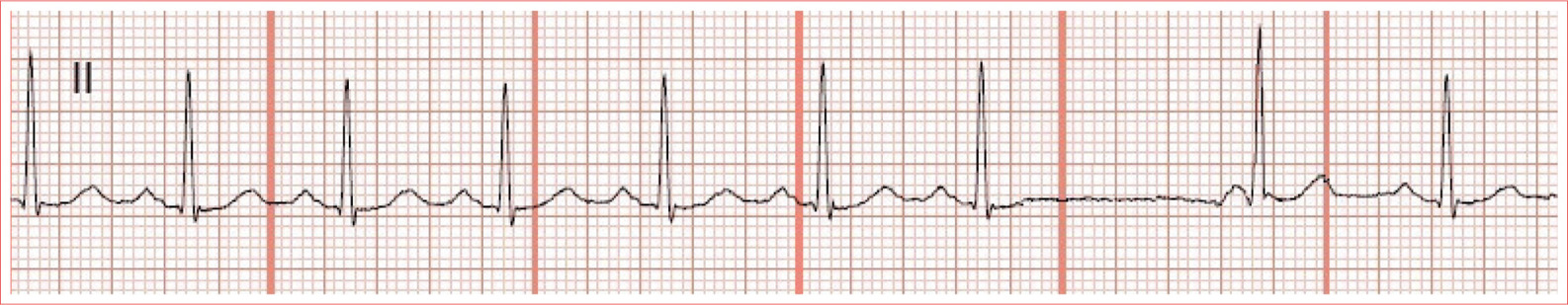 Occurs after delay in sinus activity P wave with different morphology than - photo 10