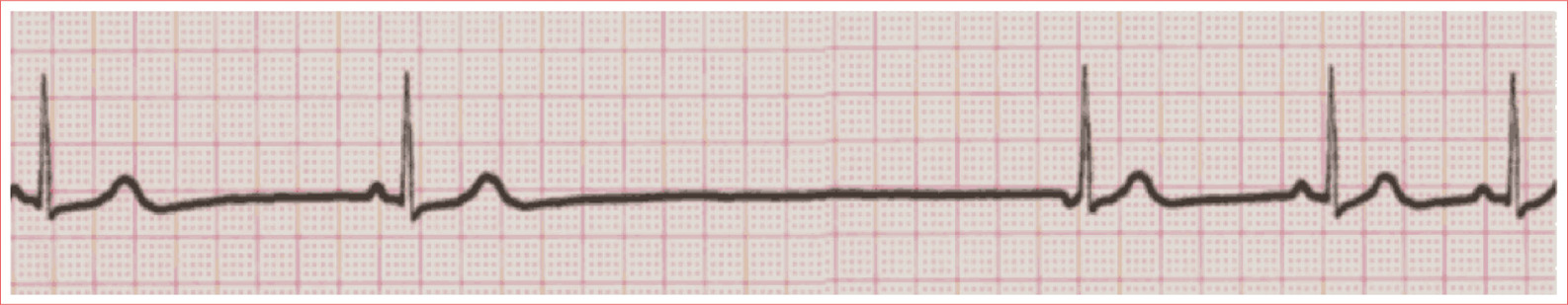 Occurs after delay in sinus activity Rhythm is regular Narrow QRS complex P - photo 11