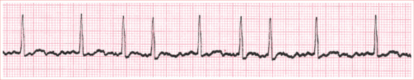 Irregularly irregular ventricular response Ventricular rate is commonly between - photo 12