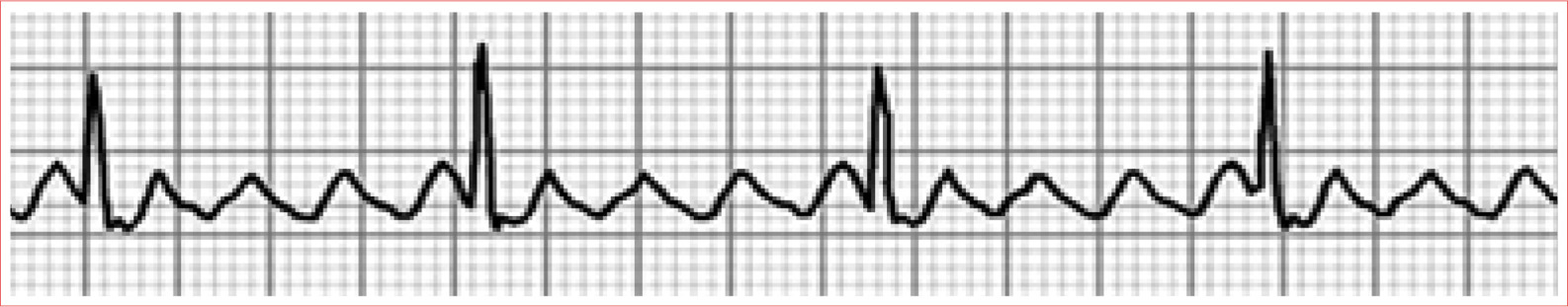 May have regular or irregular ventricular response Ventricular rate is commonly - photo 13