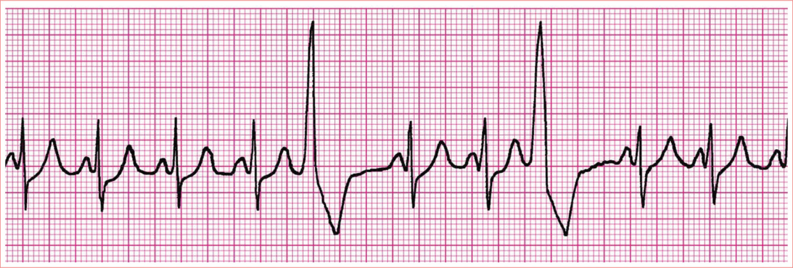 No apparent P wave Premature QRS complex Wide QRS gt012 second Bizarre - photo 14