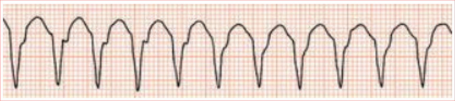 Three or more consecutive PVCs with same morphology Regular rhythm Rate greater - photo 15