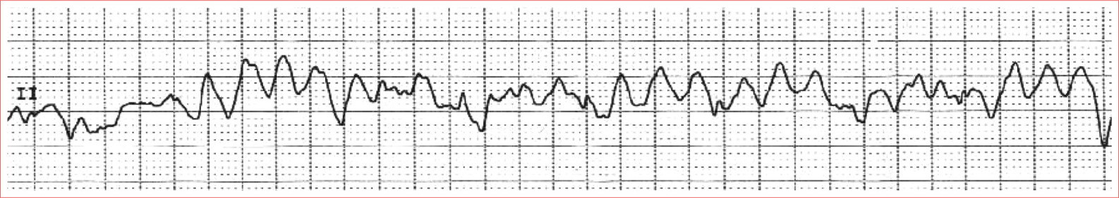 Fibrillatory waves Irregular Rate 150 to 500 quiversminute Torsades de Pointes - photo 16