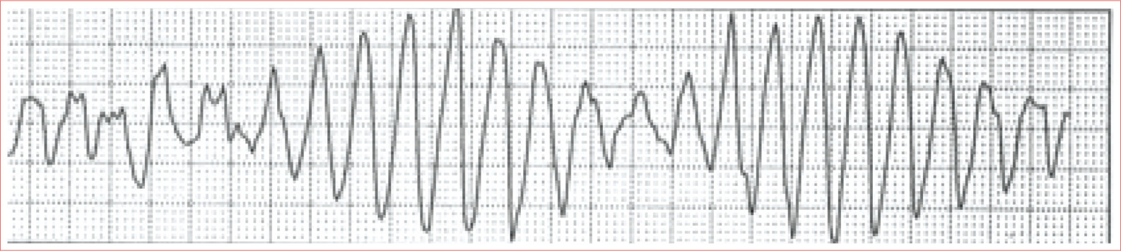 Irregular rhythm Rate 150 to 200 beatsminute Gradual shift in both axis and - photo 17