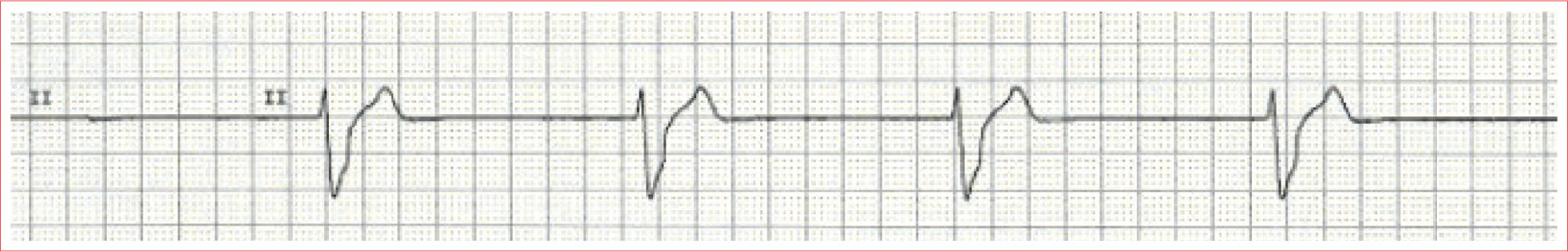 Regular rhythm No P waves Wide QRS Rate is 20 to 50 beatsminute Accelerated - photo 18