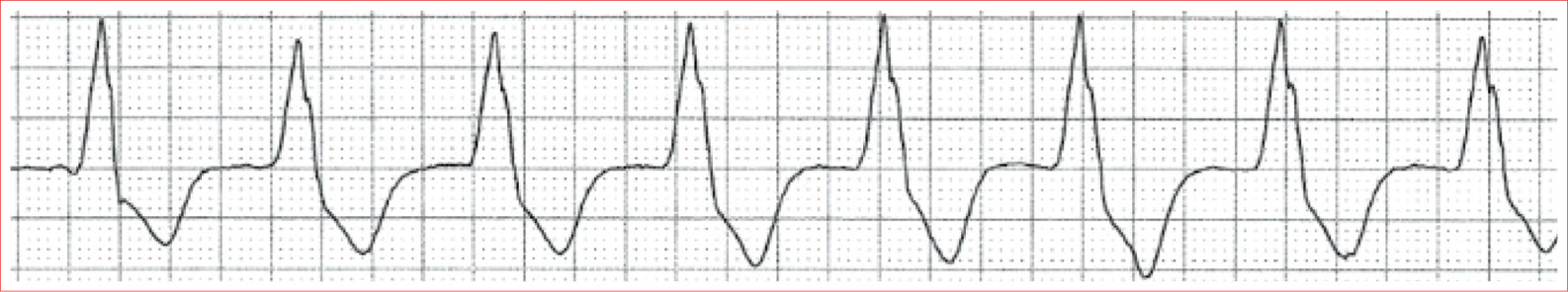 Regular rhythm Absence of P waves Wide QRS Rate 60 to 100 beatsminute AV HEART - photo 19