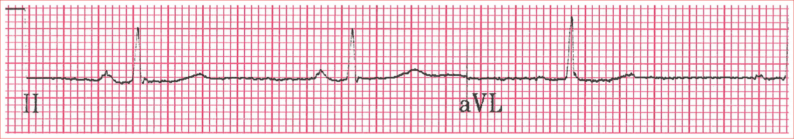 Regular rhythm Rate less than 60 beatsminute QRS complexes are typically less - photo 2