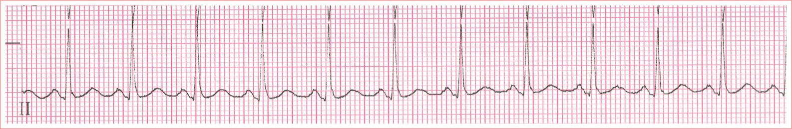 Regular rhythm Rate greater than 100 beatsminute QRS complexes are typically - photo 3