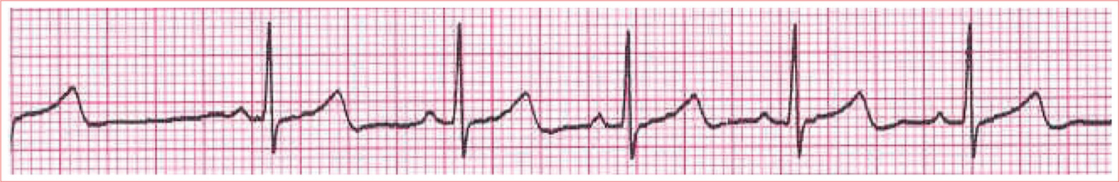 Irregular rhythm P-P varies by more than 016 second QRS complexes are - photo 4