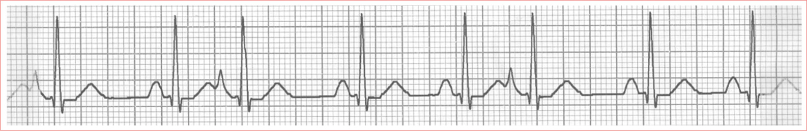 The P wave occurs before the next P wave was due The P wave has a different - photo 5