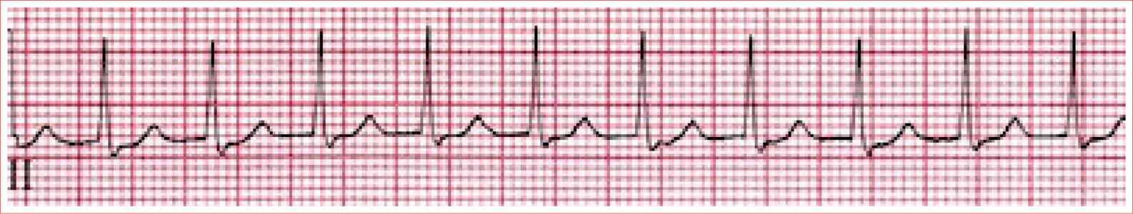 Regular rhythm Rate usually 140 to 220 beatsminute QRS is typically narrow P - photo 6