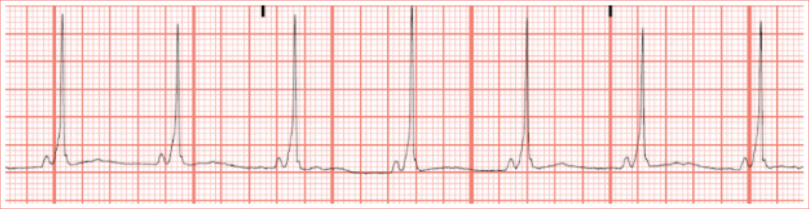 Short PR interval Delta wave slurred upstroke to start QRS Prolonged QRS - photo 7