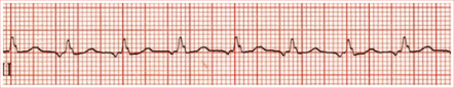 Regular rhythm Rate greater than 100 beatsminute QRS complex is typically - photo 8