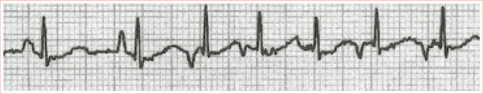 Rhythm is irregularly irregular MAT rate greater than 100 beatsminute WAP rate - photo 9