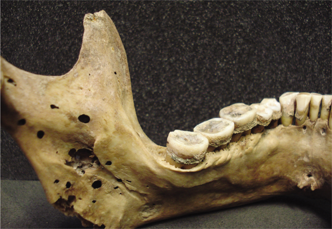 Worn teeth with calculus of an adult male from the Roman period Fumigating - photo 4