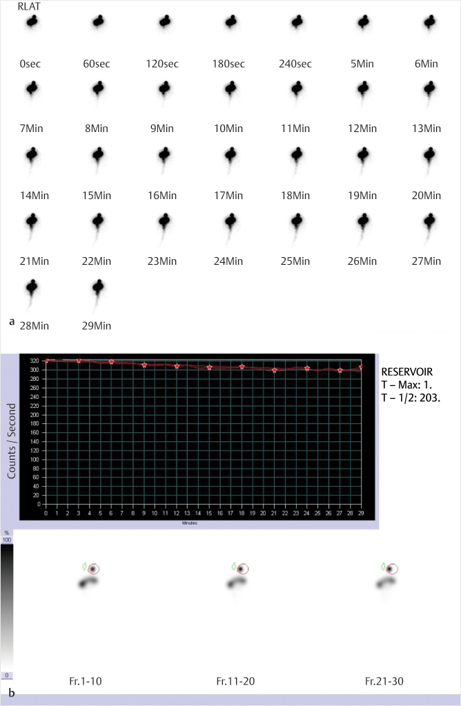 Fig 11 Cerebrospinal fluid CSF flow study with indium-111 In-111 - photo 1