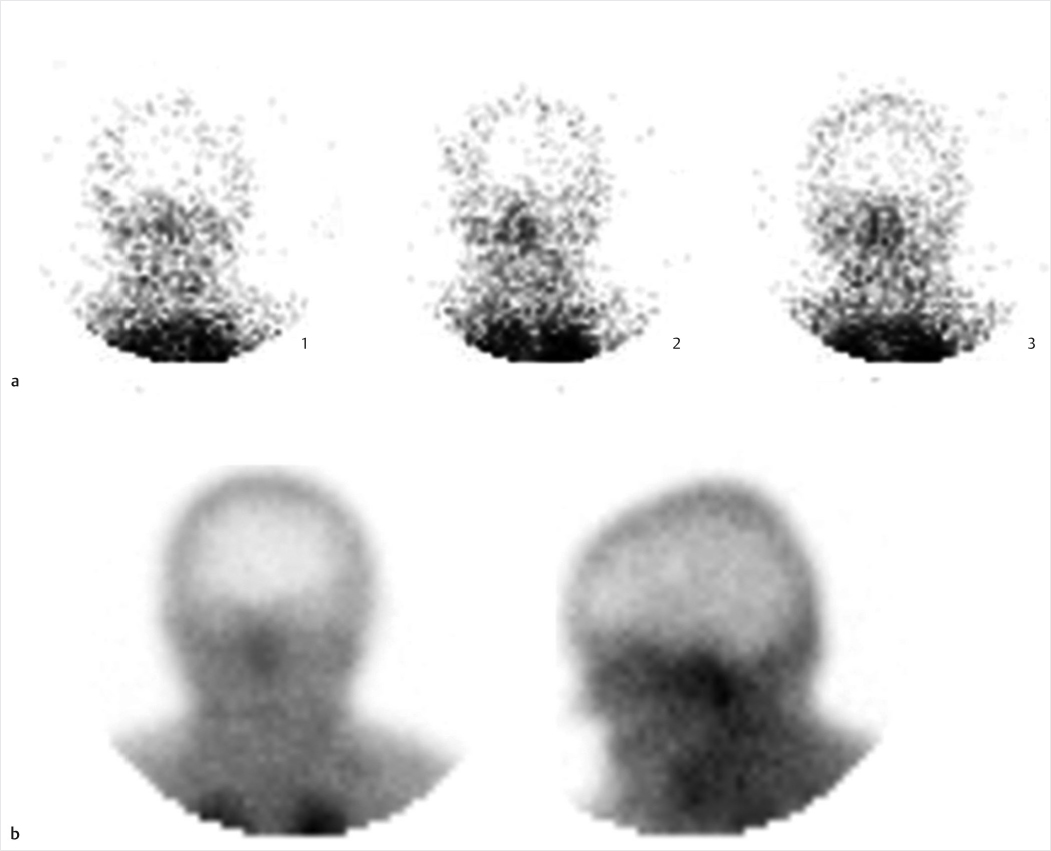 Fig 21 Brain death study with Technetium-99m Tc-99m - photo 2