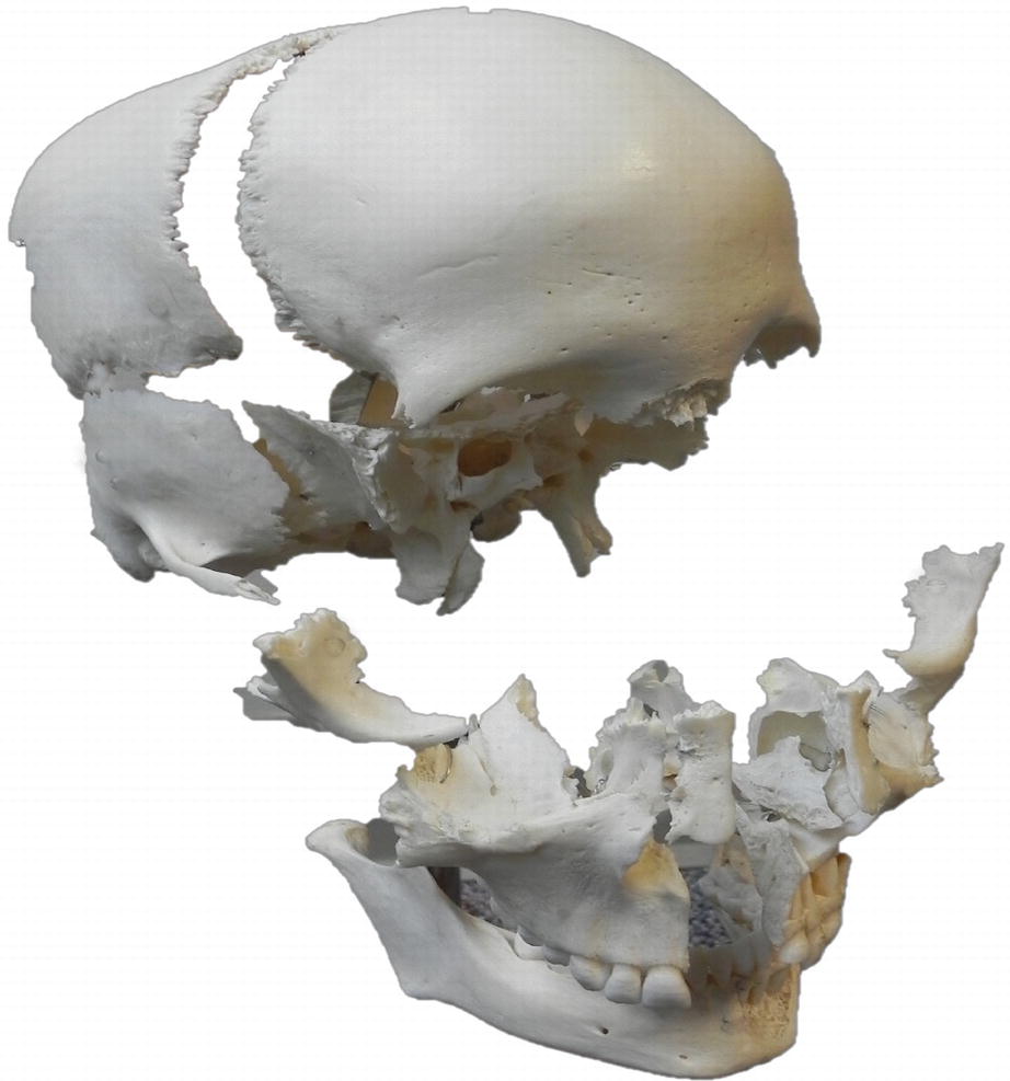 Fig 11 Beauchenne preparation of the human skull noting the articulations - photo 3