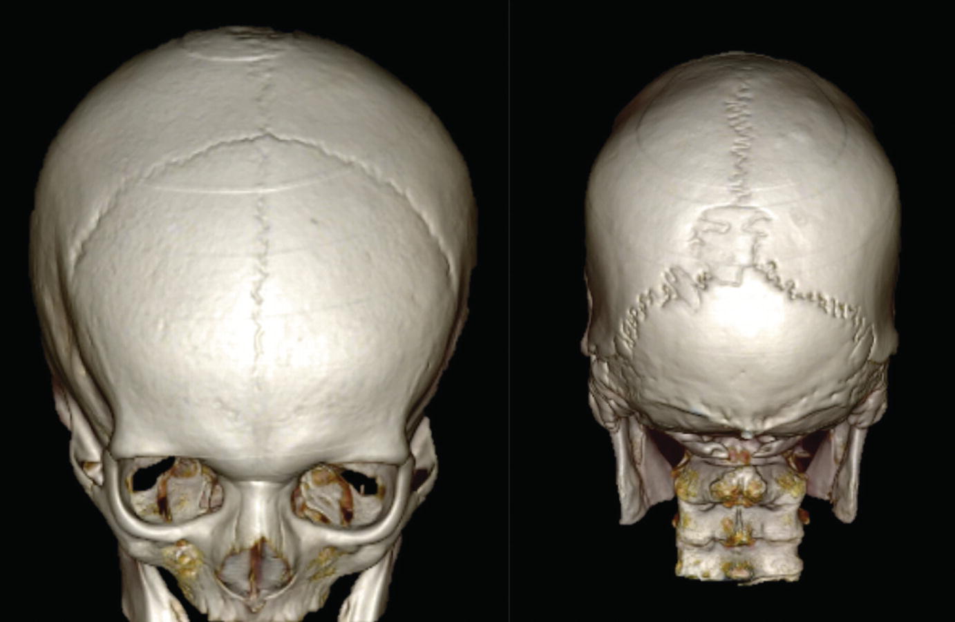 Fig 12 3D reconstructed CT of the skull anterior and posterior views The - photo 4