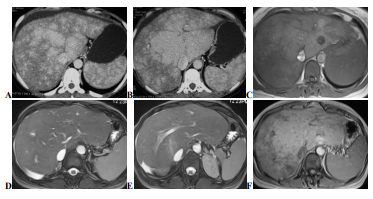 Enhanced CT scan axial A B and MR scan axial T1 C axial T2 fat - photo 1