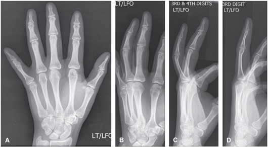 FIGURE 1 A PA hand B Oblique of fingers C D Lateral of fingersTHUMB - photo 1