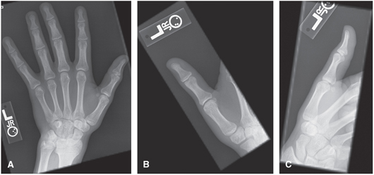 FIGURE 2 A PA hand B PA thumb C Lateral thumbHAND Routine This includes - photo 2