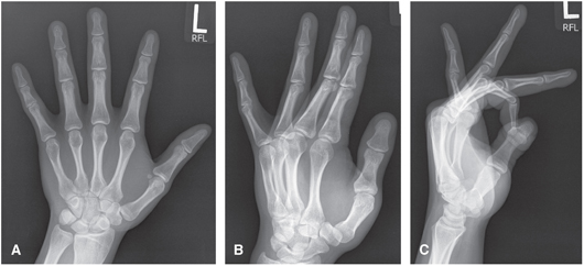 FIGURE 3 A PA of hand B Oblique of hand C Lateral of handHAND Arthritis - photo 3