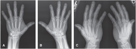 FIGURE 4 A B PA of each hand C AP Norgaard projection ball-catchers - photo 4