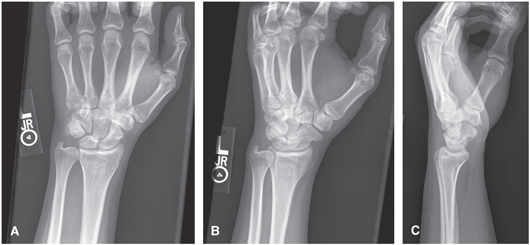 FIGURE 5 A PA wrist B Ulnar oblique wrist C Lateral wristTrauma - photo 5