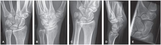 FIGURE 6 A PA wrist B Ulnar oblique wrist C Radial oblique wrist D - photo 6