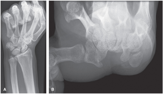 FIGURE 7 A Clenched fist B Carpal tunnel viewsFOREARM Good for trauma - photo 7