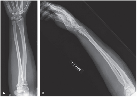 FIGURE 8 A AP forearm B Lateral forearmELBOW Nontrauma Chronic injuries - photo 8